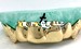gold canine teeth caps