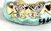 gold tooth value